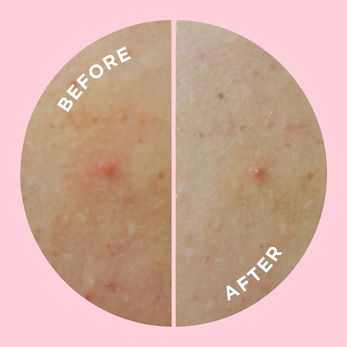 ZitSticka Pimple Patches | Face & Body | Hydrocolloid Patches | Cover Zits & Blemishes | Acne Patches or Zit Spot Stickers | Body Blemish Patch | GOO GETTER BODY PATCH | Pack of 9