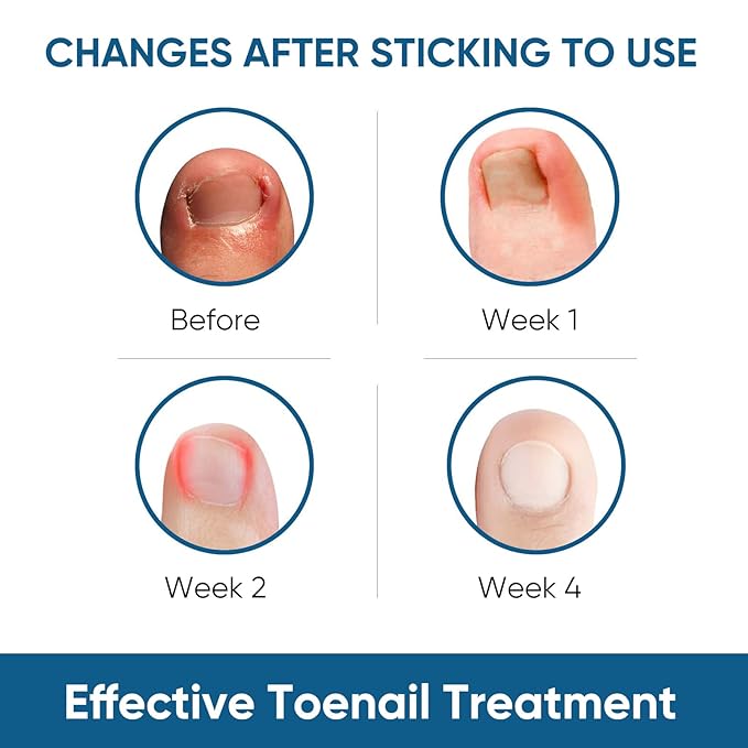 Ingrown Toenail Treatment, 60Pcs Ingrown Toenail Corrector Strips, Ingrown Toenail Removal Kit with File and Lifter, 60Pcs