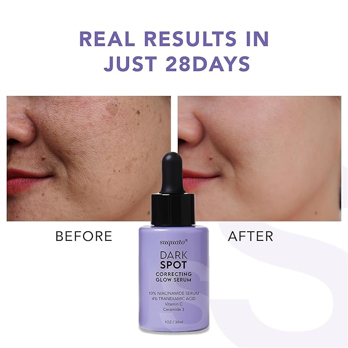Dark Spot Correcting Glow Serum: Melasma Hyperpigmentation Treatment for Face with Tranexamic Acid Niacinamide - Vitamin C Serum and Dark Spot Remover For Face