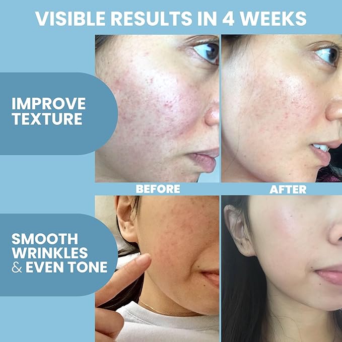 Collagen Peptide Serum for Face – Anti Aging Facial Treatment with Peptides & Hyaluronic Acid – Gentle Formula for Sensitive Skin, Microneedling Pen, Derma Roller, Skin Firming & Hydrating (2 Oz)