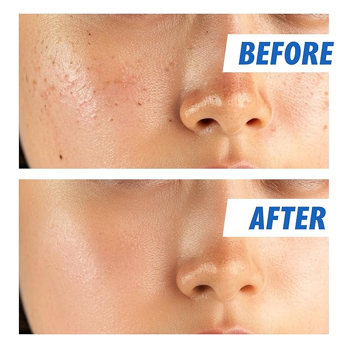 Nightingale Ecto-hyaluronic Ampoule with Hyaluronic Acid, Ectoin, Hydrating Face Serum for Dry Skin, Non-greasy formula, Hypoallergenic, Fragrance & Alcohol Free, Allergen Free, Cruelty Free, Vegan